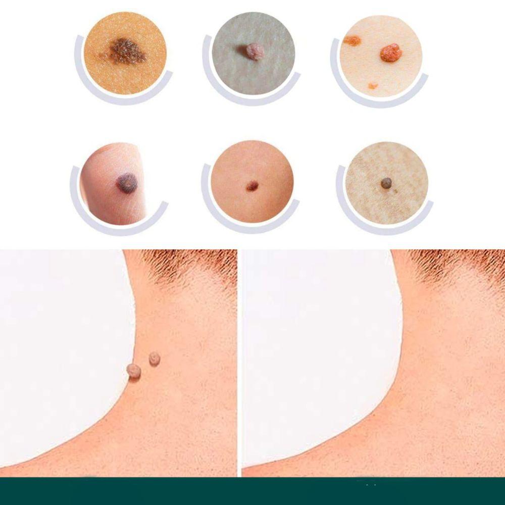 Ripob | SkinClear Hautwarzenentferner | Pflaster zur Entfernung von Hautwarzen & Warzen | Hydrocolloid-Technologie | Schmerzfrei & Diskret | Für alle Hauttypen geeignet | 144 Stück